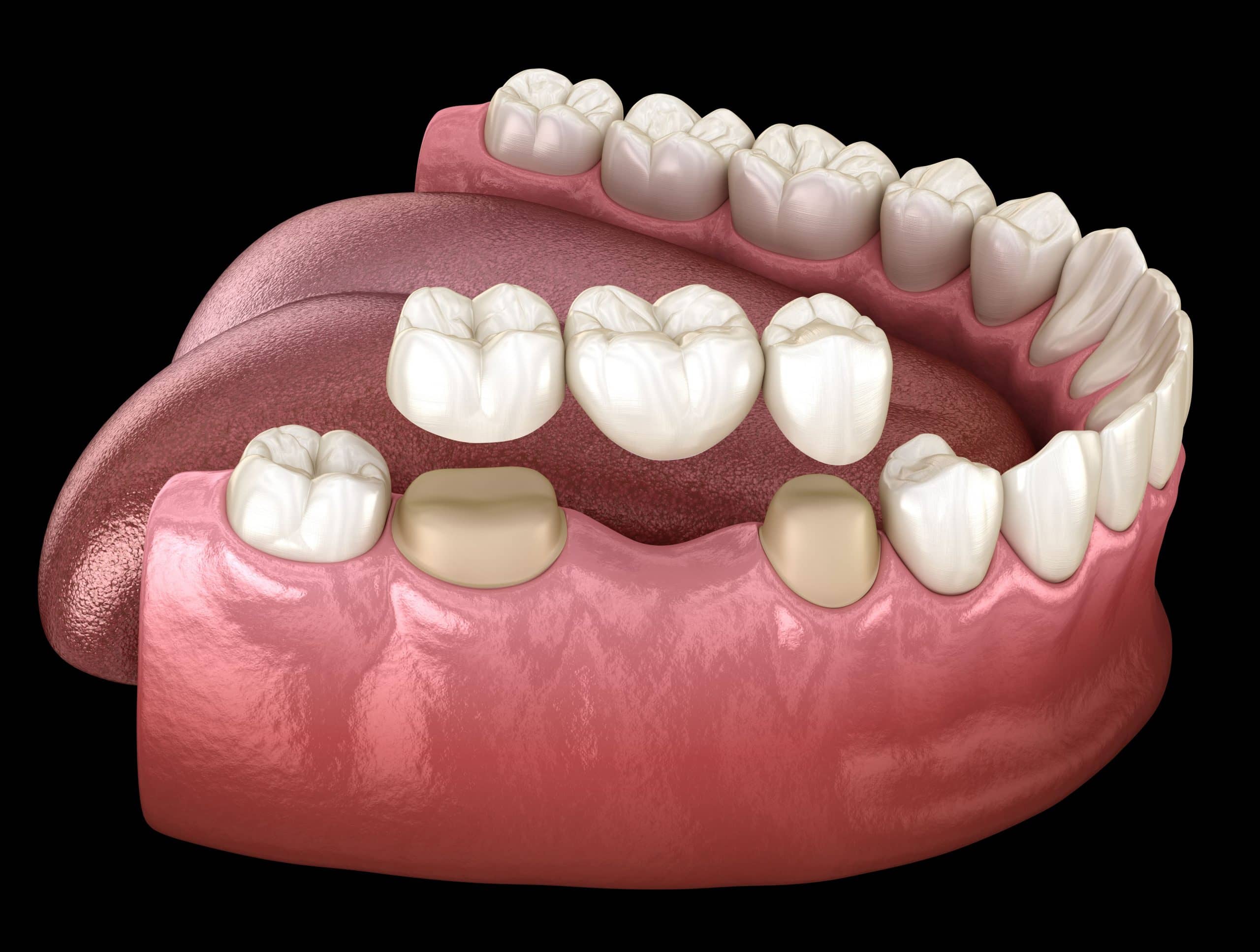 Dental Bridges - Westwood Dental | Dentist in Langley, Berkshire